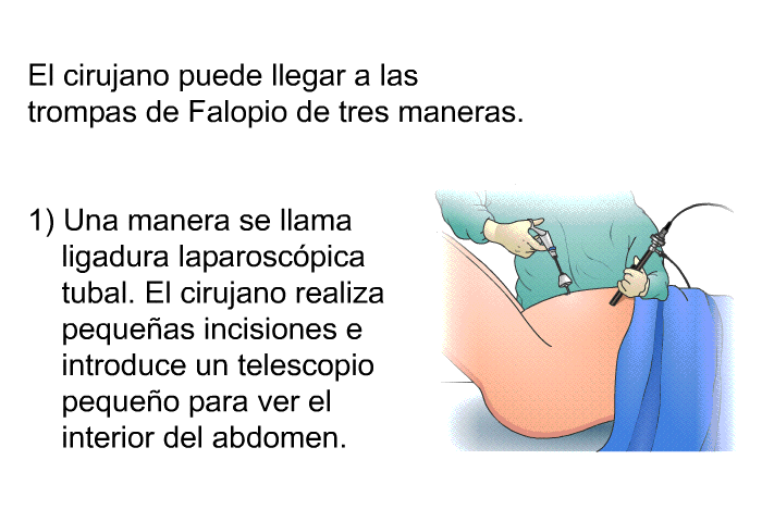 El cirujano puede llegar a las trompas de Falopio de tres maneras.  Una manera se llama ligadura laparoscpica tubal. El cirujano realiza pequeas incisiones e introduce un telescopio pequeo para ver el interior del abdomen.