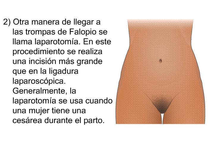 Otra manera de llegar a las trompas de Falopio se llama laparotoma. En este procedimiento se realiza una incisin ms grande que en la ligadura laparoscpica. Generalmente, la laparotoma se usa cuando una mujer tiene una cesrea durante el parto.