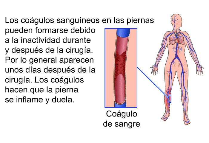 Los cogulos sanguneos en las piernas pueden formarse debido a la inactividad durante y despus de la ciruga. Por lo general aparecen unos das despus de la ciruga. Los cogulos hacen que la pierna se inflame y duela.