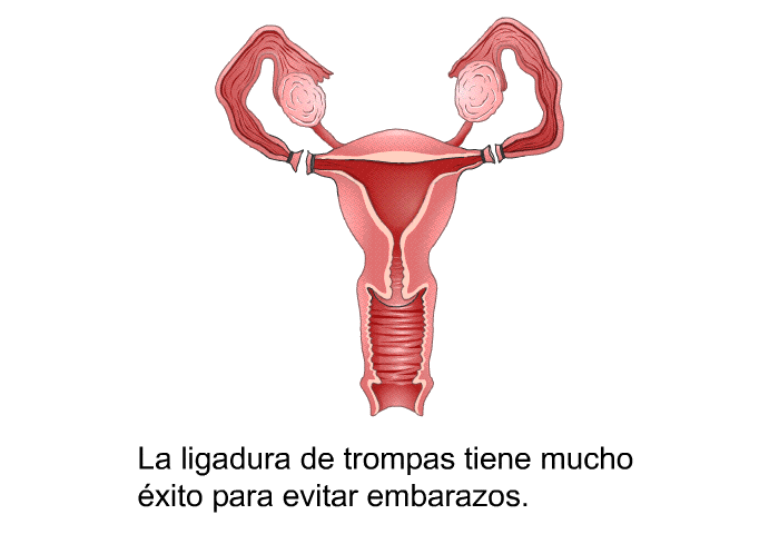 La ligadura de trompas tiene mucho �xito para evitar embarazos.