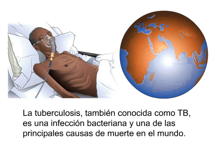 La tuberculosis, tambin conocida como TB, es una infeccin bacteriana y una de las principales causas de muerte en el mundo.