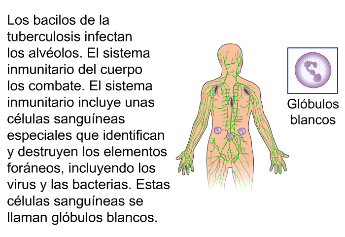 Los bacilos de la tuberculosis infectan los alvolos. El sistema inmunitario del cuerpo los combate. El sistema inmunitario incluye unas clulas sanguneas especiales que identifican y destruyen los elementos forneos, incluyendo los virus y las bacterias. Estas clulas sanguneas se llaman glbulos blancos.