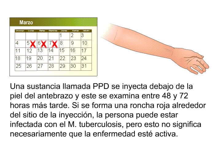 Una sustancia llamada PPD se inyecta debajo de la piel del antebrazo y este se examina entre 48 y 72 horas ms tarde. Si se forma una roncha roja alrededor del sitio de la inyeccin, la persona puede estar infectada con el <I>M. tuberculosis</I>, pero esto no significa necesariamente que la enfermedad est activa.