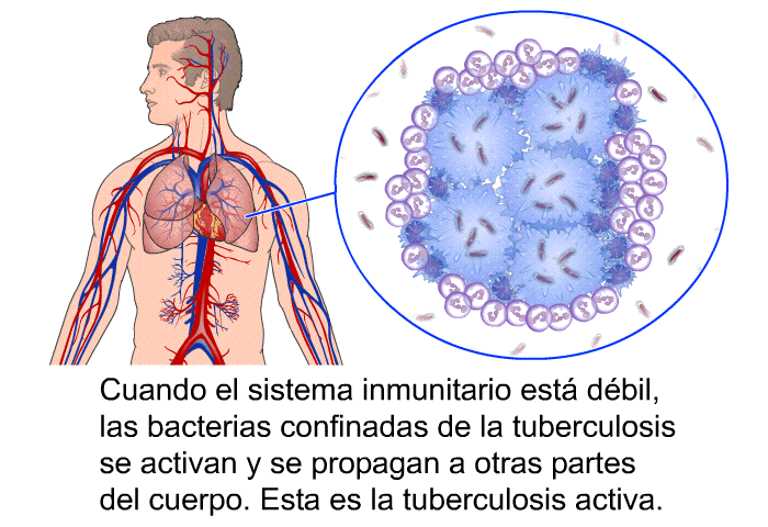 Cuando el sistema inmunitario est� d�bil, las bacterias confinadas de la tuberculosis se activan y se propagan a otras partes del cuerpo. Esta es la tuberculosis activa.