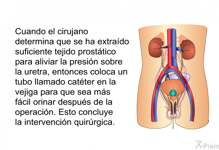 Cuando el cirujano determina que se ha extrado suficiente tejido prosttico para aliviar la presin sobre la uretra, entonces coloca un tubo llamado catter en la vejiga para que sea ms fcil orinar despus de la operacin. Esto concluye la intervencin quirrgica.