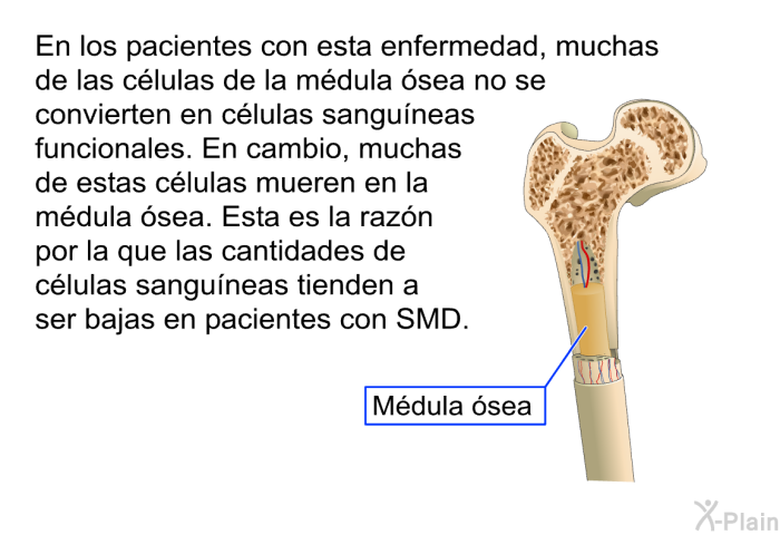 En los pacientes con esta enfermedad, muchas de las clulas de la mdula sea no se convierten en clulas sanguneas funcionales. En cambio, muchas de estas clulas mueren en la mdula sea. Esta es la razn por la que las cantidades de clulas sanguneas tienden a ser bajas en pacientes con SMD.