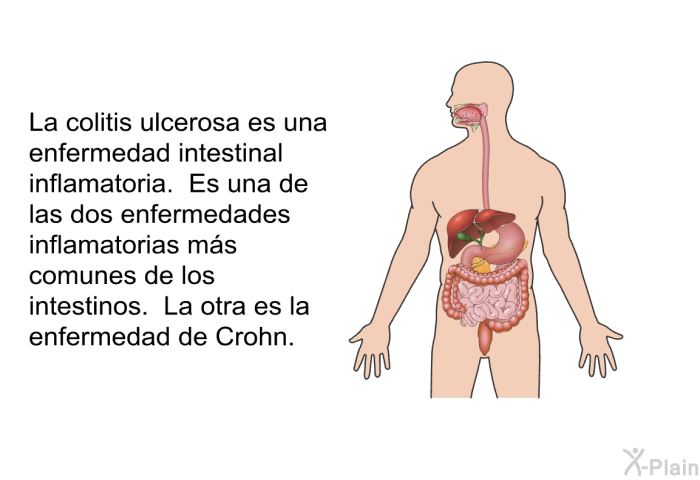 La colitis ulcerosa es una enfermedad intestinal inflamatoria. Es una de las dos enfermedades inflamatorias ms comunes de los intestinos. La otra es la enfermedad de Crohn.