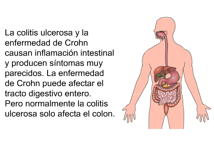 La colitis ulcerosa y la enfermedad de Crohn causan inflamacin intestinal y producen sntomas muy parecidos. La enfermedad de Crohn puede afectar el tracto digestivo entero. Pero normalmente la colitis ulcerosa solo afecta el colon.