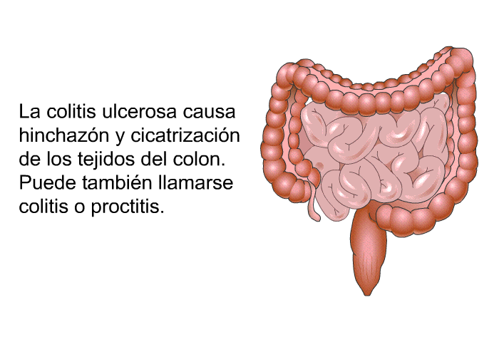 La colitis ulcerosa causa hinchazn y cicatrizacin de los tejidos del colon. Puede tambin llamarse colitis o proctitis.
