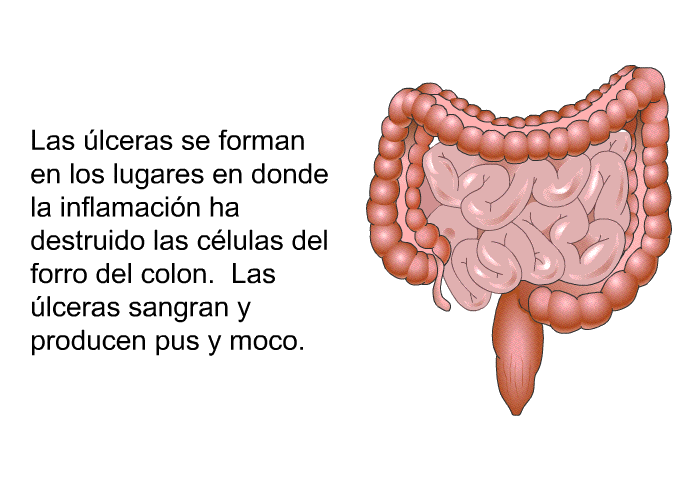 Las lceras se forman en los lugares en donde la inflamacin ha destruido las clulas del forro del colon. Las lceras sangran y producen pus y moco.
