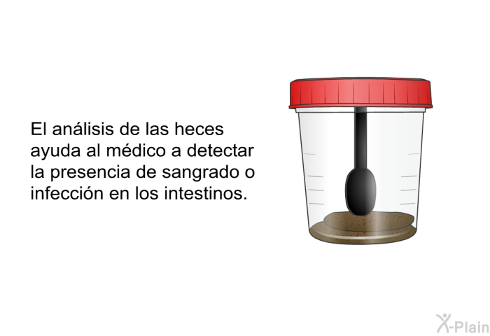 El anlisis de las heces ayuda al mdico a detectar la presencia de sangrado o infeccin en los intestinos.