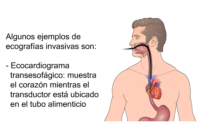 Algunos ejemplos de ecografas invasivas son:  Ecocardiograma transesofgico: muestra el corazn mientras el transductor est ubicado en el tubo alimenticio