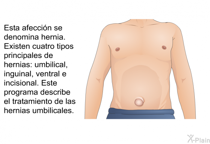 Esta afeccin se denomina hernia. Existen cuatro tipos principales de hernias: umbilical, inguinal, ventral e incisional. Este programa describe el tratamiento de las hernias umbilicales.