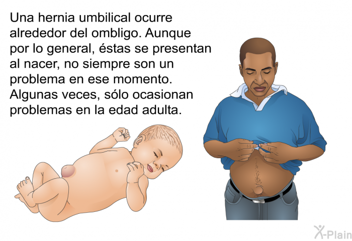 Una hernia umbilical ocurre alrededor del ombligo. Aunque por lo general, stas se presentan al nacer, no siempre son un problema en ese momento. Algunas veces, slo ocasionan problemas en la edad adulta.