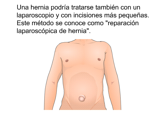Una hernia podr�a tratarse tambi�n con un laparoscopio y con incisiones m�s peque�as. Este m�todo se conoce como &ldquo;reparaci�n laparosc�pica de hernia&rdquo;.