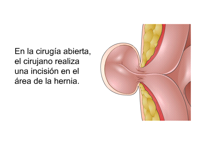 En la cirug�a abierta, el cirujano realiza una incisi�n en el �rea de la hernia.