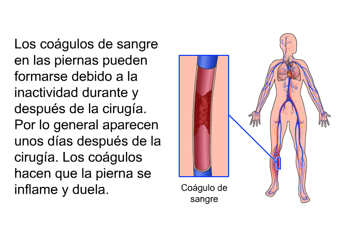 Los co�gulos de sangre en las piernas pueden formarse debido a la inactividad durante y despu�s de la cirug�a. Por lo general aparecen unos d�as despu�s de la cirug�a. Los co�gulos hacen que la pierna se inflame y duela.