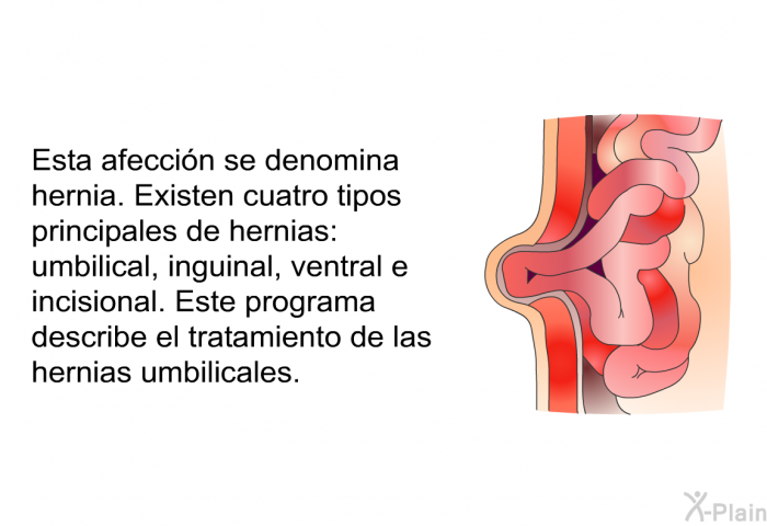 Esta afeccin se denomina hernia. Existen cuatro tipos principales de hernias: umbilical, inguinal, ventral e incisional. Este programa describe el tratamiento de las hernias umbilicales.