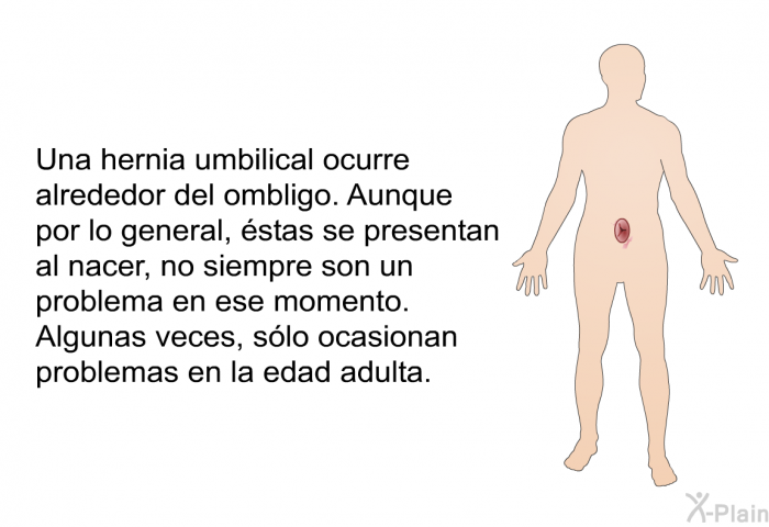 Una hernia umbilical ocurre alrededor del ombligo. Aunque por lo general, stas se presentan al nacer, no siempre son un problema en ese momento. Algunas veces, slo ocasionan problemas en la edad adulta.