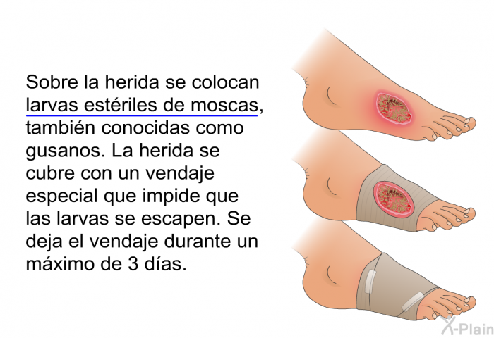 Sobre la herida se colocan larvas estriles de moscas, tambin conocidas como gusanos. La herida se cubre con un vendaje especial que impide que las larvas se escapen. Se deja el vendaje durante un mximo de 3 das.
