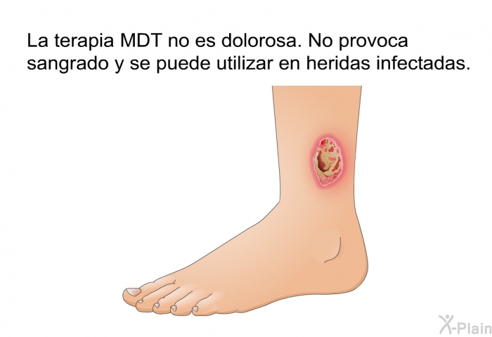 La terapia MDT no es dolorosa. No provoca sangrado y se puede utilizar en heridas infectadas.