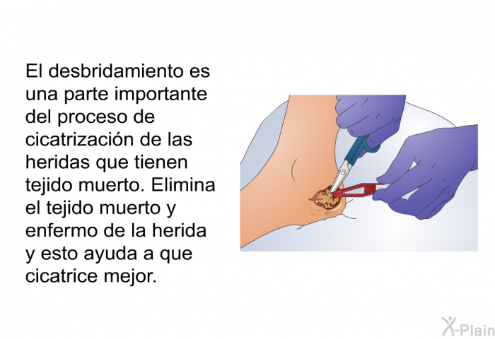 El desbridamiento es una parte importante del proceso de cicatrizacin de las heridas que tienen tejido muerto. Elimina el tejido muerto y enfermo de la herida y esto ayuda a que cicatrice mejor.