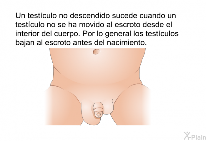 Un testculo no descendido sucede cuando un testculo no se ha movido al escroto desde el interior del cuerpo. Por lo general los testculos bajan al escroto antes del nacimiento.