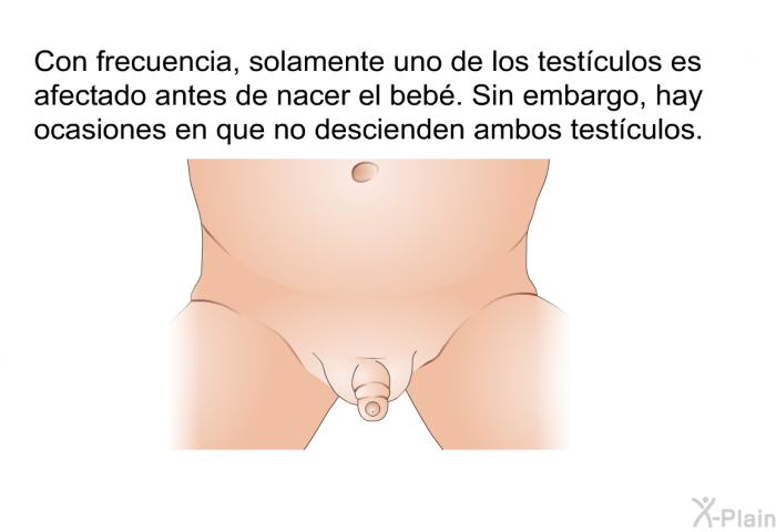 Con frecuencia, solamente uno de los testculos es afectado antes de nacer el beb. Sin embargo, hay ocasiones en que no descienden ambos testculos.