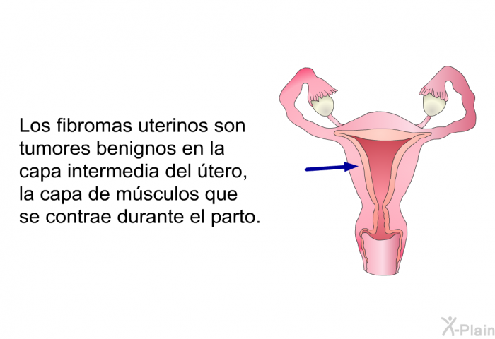 Los fibromas uterinos son tumores benignos en la capa intermedia del tero, la capa de msculos que se contrae durante el parto.