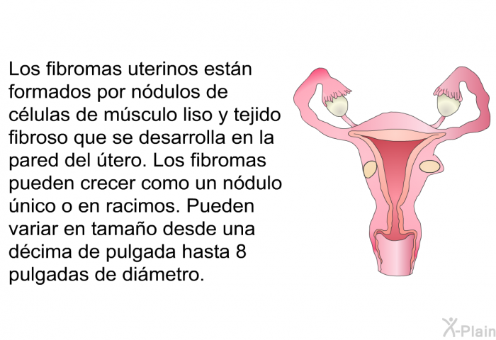 Los fibromas uterinos estn formados por ndulos de clulas de msculo liso y tejido fibroso que se desarrolla en la pared del tero. Los fibromas pueden crecer como un ndulo nico o en racimos. Pueden variar en tamao desde una dcima de pulgada hasta 8 pulgadas de dimetro.