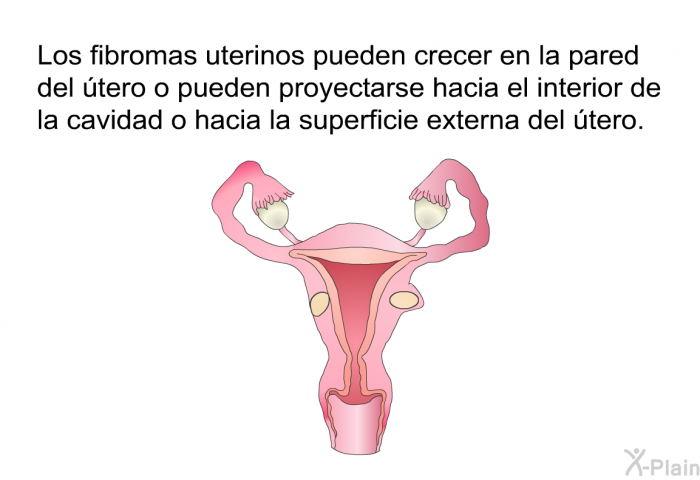 Los fibromas uterinos pueden crecer en la pared del tero o pueden proyectarse hacia el interior de la cavidad o hacia la superficie externa del tero.