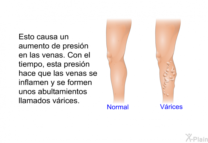 Esto causa un aumento de presin en las venas. Con el tiempo, esta presin hace que las venas se inflamen y se formen unos abultamientos llamados vrices.