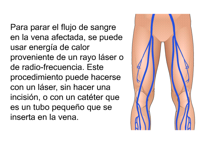 Para parar el flujo de sangre en la vena afectada, se puede usar energa de calor proveniente de un rayo lser o de radio-frecuencia. Este procedimiento puede hacerse con un lser, sin hacer una incisin, o con un catter que es un tubo pequeo que se inserta en la vena.