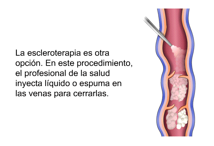 La escleroterapia es otra opcin. En este procedimiento, el profesional de la salud inyecta lquido o espuma en las venas para cerrarlas.