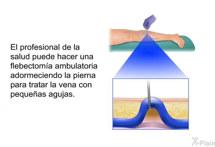 El profesional de la salud puede hacer una flebectoma ambulatoria adormeciendo la pierna para tratar la vena con pequeas agujas.