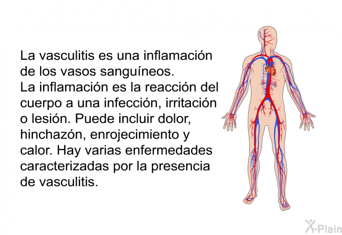 La vasculitis es una inflamacin de los vasos sanguneos. La inflamacin es la reaccin del cuerpo a una infeccin, irritacin o lesin. Puede incluir dolor, hinchazn, enrojecimiento y calor. Hay varias enfermedades caracterizadas por la presencia de vasculitis.