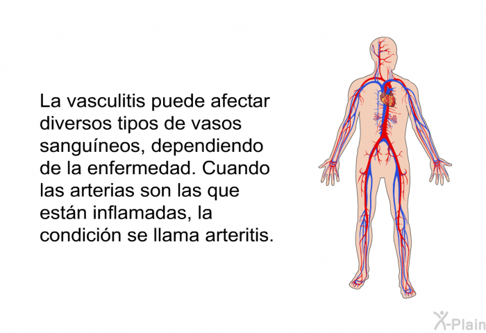 La vasculitis puede afectar diversos tipos de vasos sanguneos, dependiendo de la enfermedad. Cuando las arterias son las que estn inflamadas, la condicin se llama <I>arteritis</I>.