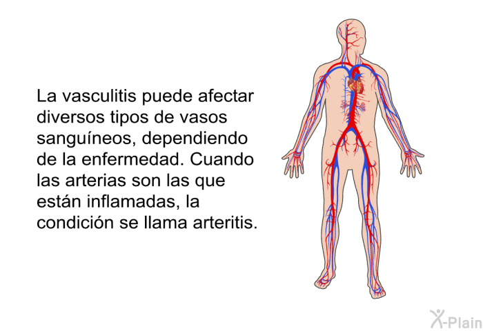 La vasculitis puede afectar diversos tipos de vasos sanguneos, dependiendo de la enfermedad. Cuando las arterias son las que estn inflamadas, la condicin se llama <I>arteritis</I>.