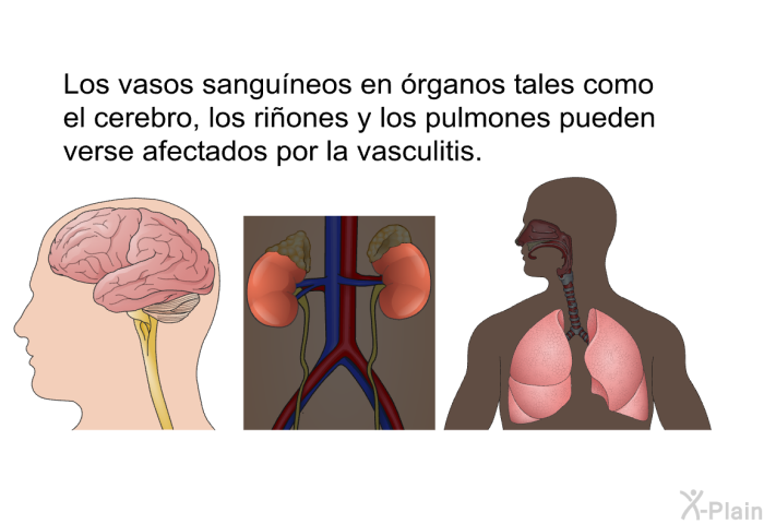 Los vasos sanguneos en rganos tales como el cerebro, los riones y los pulmones pueden verse afectados por la vasculitis.