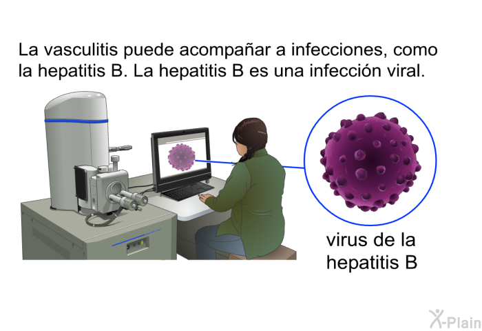 La vasculitis puede acompaar a infecciones, como la hepatitis B. La hepatitis B es una infeccin viral.
