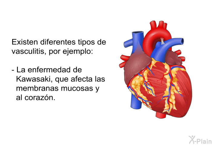Existen diferentes tipos de vasculitis, por ejemplo:  La enfermedad de Kawasaki, que afecta las membranas mucosas y al corazn.