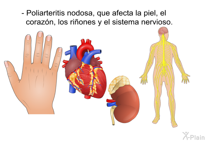 Poliarteritis nodosa, que afecta la piel, el corazn, los riones y el sistema nervioso.