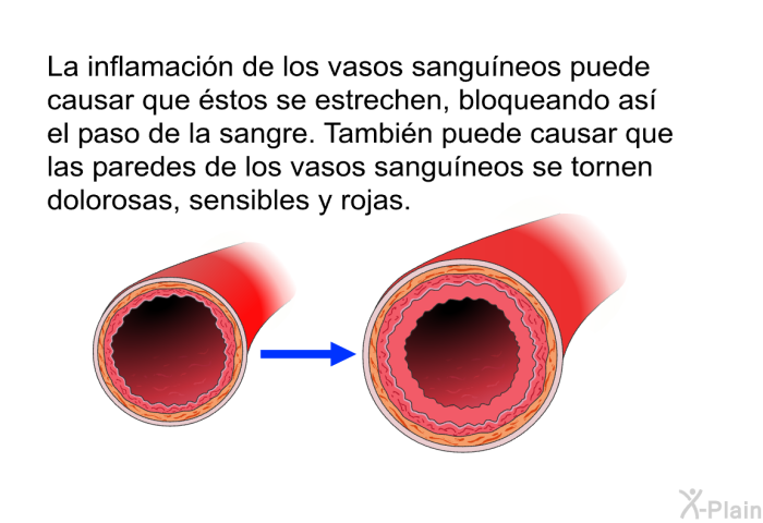 La inflamacin de los vasos sanguneos puede causar que stos se estrechen, bloqueando as el paso de la sangre. Tambin puede causar que las paredes de los vasos sanguneos se tornen dolorosas, sensibles y rojas.
