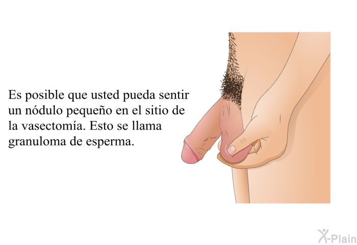 Es posible que usted pueda sentir un ndulo pequeo en el sitio de la vasectoma. Esto se llama <I>granuloma de esperma</I>.