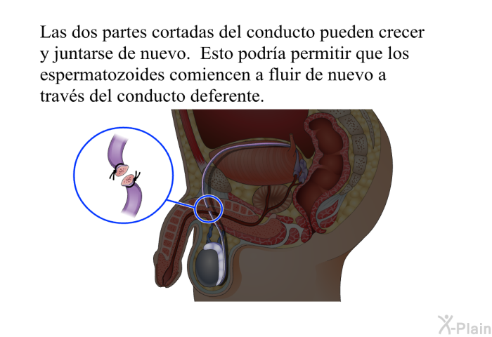Las dos partes cortadas del conducto pueden crecer y juntarse de nuevo. Esto podra permitir que los espermatozoides comiencen a fluir de nuevo a travs del conducto deferente.