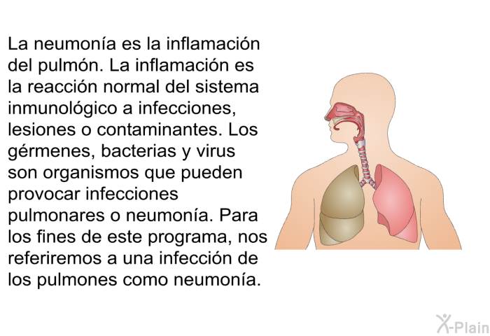 La neumona es la inflamacin del pulmn. La inflamacin es la reaccin normal del sistema inmunolgico a infecciones, lesiones o contaminantes. Los grmenes, bacterias y virus son organismos que pueden provocar infecciones pulmonares o neumona. Para los fines de este programa, nos referiremos a una infeccin de los pulmones como neumona.