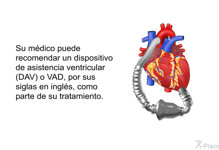 Su mdico puede recomendar un dispositivo de asistencia ventricular (DAV) o VAD, por sus siglas en ingls, como parte de su tratamiento.