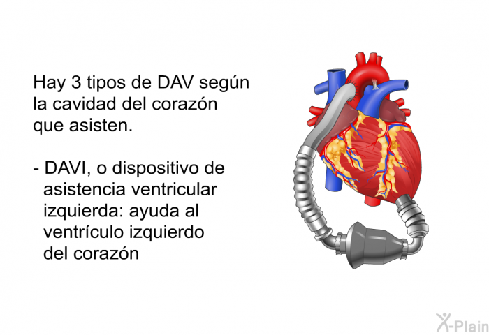 Hay 3 tipos de DAV segn la cavidad del corazn que asisten.  DAVI, o dispositivo de asistencia ventricular izquierda: ayuda al ventrculo izquierdo del corazn