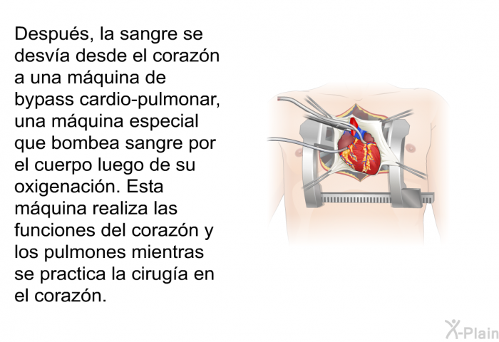 Despu�s, la sangre se desv�a desde el coraz�n a una m�quina de bypass cardio-pulmonar, una m�quina especial que bombea sangre por el cuerpo luego de su oxigenaci�n.&nbsp;Esta m�quina realiza las funciones del coraz�n y los pulmones mientras se practica la cirug�a en el coraz�n.