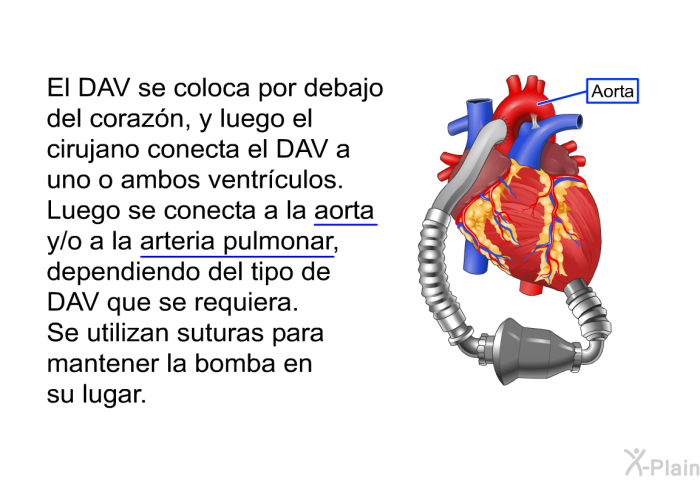 El DAV se coloca por debajo del coraz�n, y luego el cirujano conecta el DAV a uno o ambos ventr�culos.&nbsp;Luego se conecta a la aorta y/o a la arteria pulmonar, dependiendo del tipo de DAV que se requiera.&nbsp;Se utilizan suturas para mantener la bomba en su lugar.